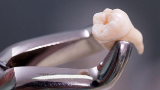 В Тюменской области женщине удалили зуб, растущий прямо в носу