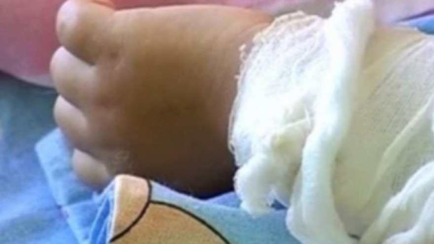 В Ноябрьске горе-родители пытались лечить ожоги у годовалого малыша зубной пастой