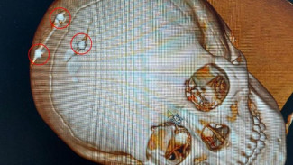 Новоуренгойские врачи спасли ребенка, пострадавшего от взорвавшегося патрона