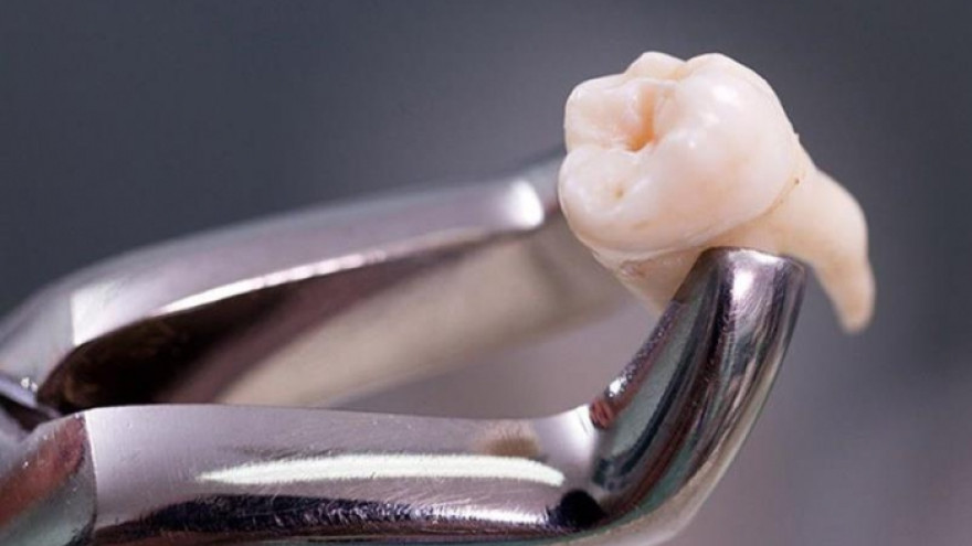 В Тюменской области женщине удалили зуб, растущий прямо в носу