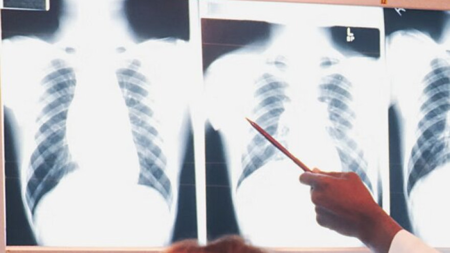 В Надыме двое больных туберкулезом горожан были принудительно госпитализированы 