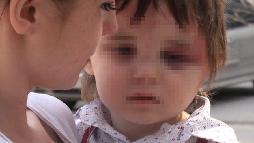Жительница Ноябрьска подозревает няню в жестоком избиении своего 3-летнего сына
