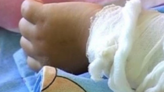 В Ноябрьске горе-родители пытались лечить ожоги у годовалого малыша зубной пастой