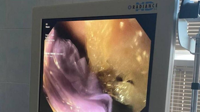 В Новом Уренгое врачи извлекли из желудка ребенка инородное тело, весом в полкилограмма