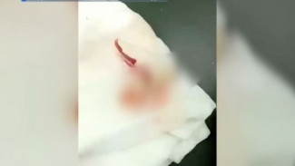Санитарка, поглумившаяся над оторванным пальцем пациентки, уволена из больницы Надыма