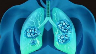 Как уберечь себя от пневмонии: губкинские медики напомнили о том, как выглядят первые симптомы